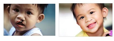 Phẫu thuật miễn phí cho trẻ em có dị tật miệng tại Thừa Thiên-Huế