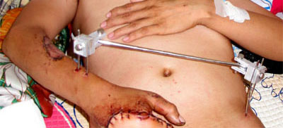 Lần đầu tiên tái tạo thành công ca tuột hết da bàn tay