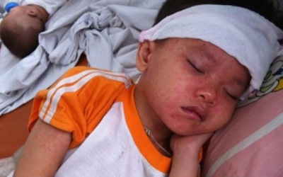 Chăm sóc sức khỏe cho người mắc bệnh sởi