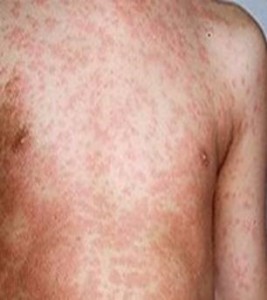 Cả nước ghi nhận thêm 55 trường hợp mắc sởi xác định trong ngày 5-5