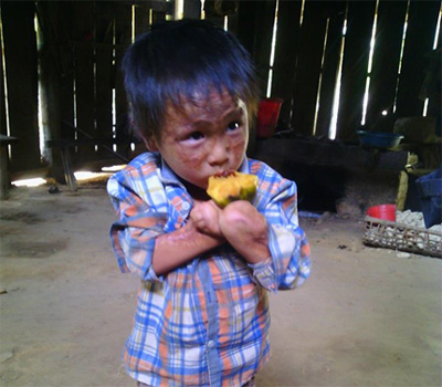 Cháu On mong đôi tay lành lặn