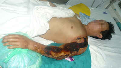 Phòng vi khuẩn ăn thịt người bằng cách nào?