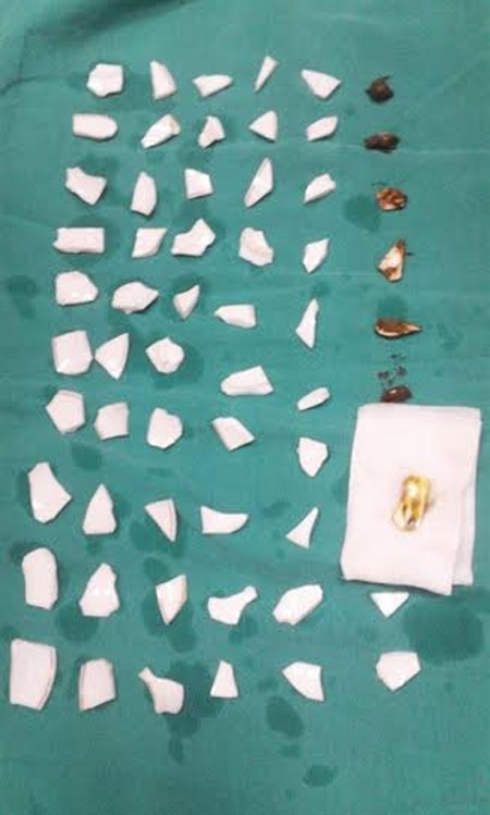 Gắp 59 mảnh chén vỡ trong dạ dày và ruột bệnh nhân