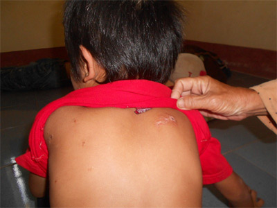 TP.Huế: Côn trùng lạ tấn công người dân là kiến ba khoang