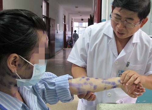 Hà Nội: Bệnh thủy đậu gia tăng mạnh