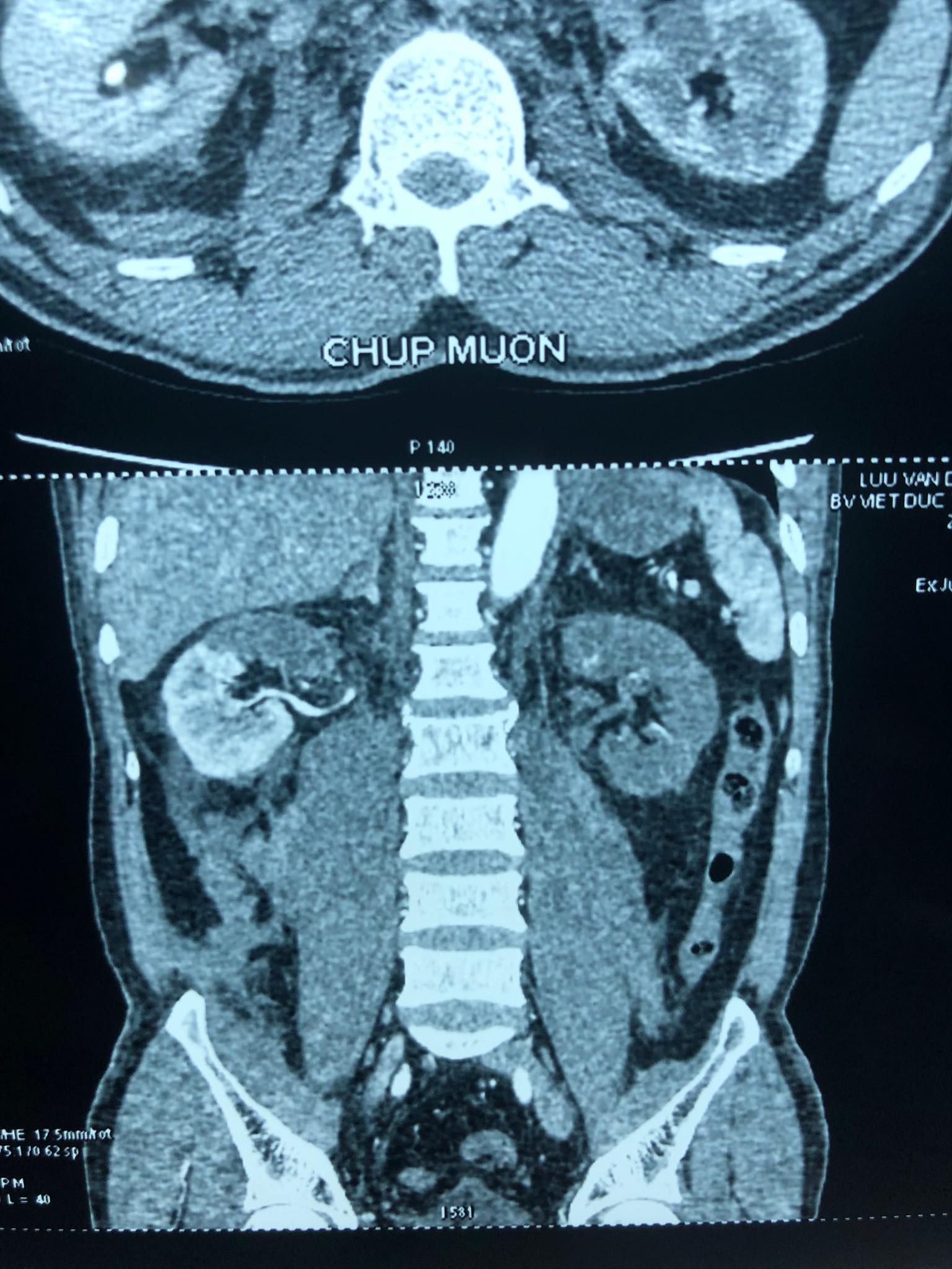 Ghép thận tự thân cứu nam thanh niên tai nạn xe máy tắc động mạch thận giờ thứ 24