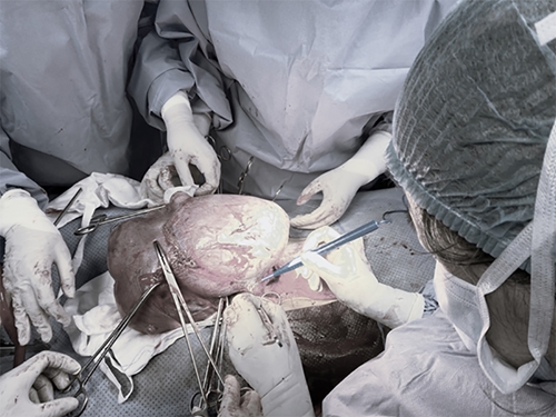 Bệnh viện Đa khoa Tâm Anh phẫu thuật thành công khối u 3,2kg cho người phụ nữ