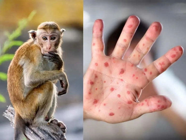 WHO sắp họp khẩn về bệnh đậu mùa khỉ