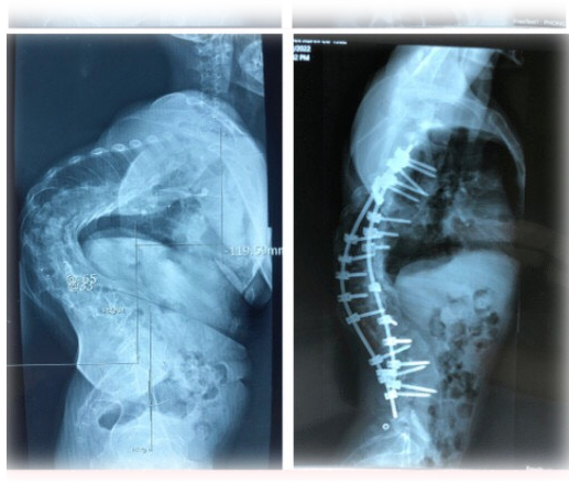 Bệnh viện Trung ương Quân đội 108: Lấy lại hình dạng bình thường cho bệnh nhân bị gù vẹo