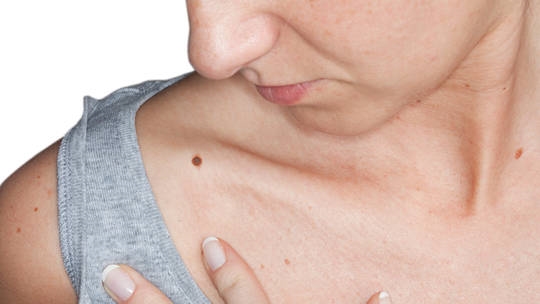 Da tiếp xúc nhiều hơn với tia cực tím, yếu tố nguy cơ gây ung thư da. Ảnh minh họa: Getty Images 