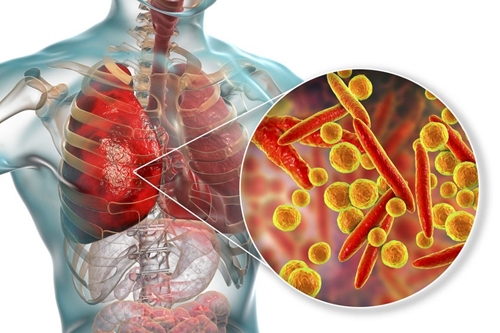 Bệnh viêm phổi và những dấu hiệu cần cảnh giác lúc giao mùa
