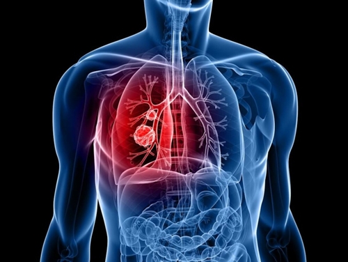 Mỹ phê chuẩn thuốc điều trị ung thư phổi tế bào nhỏ