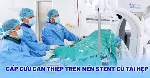 Khoan lòng mạch và đặt stent cứu sống bệnh nhân tái hẹp mạch vành nặng