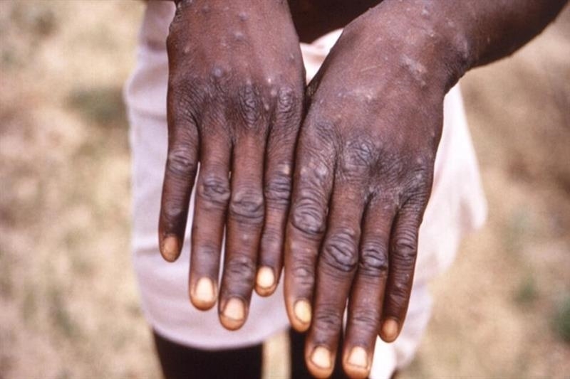 CDC châu Phi kêu gọi hành động khẩn cấp ngăn bệnh đậu mùa khỉ lây lan