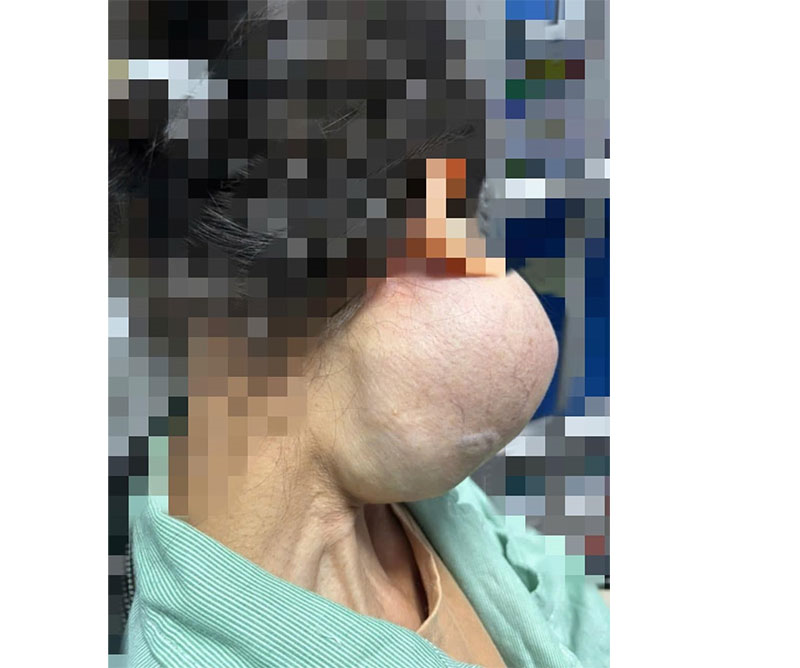 Bệnh viện Ung bướu Hà Nội: Cứu sống bệnh nhân suýt mất mạng vì chủ quan không điều trị