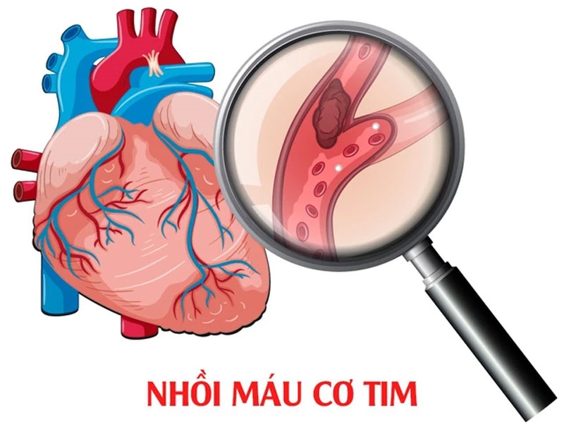 Bác sĩ của bạn: Nhồi máu cơ tim vì tập luyện cường độ cao