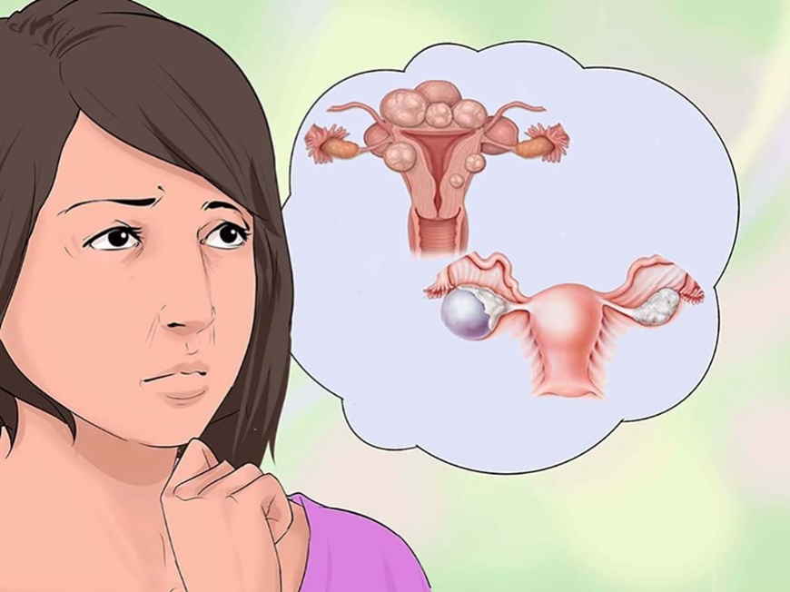 Rối loạn tâm thần do khối u buồng trứng