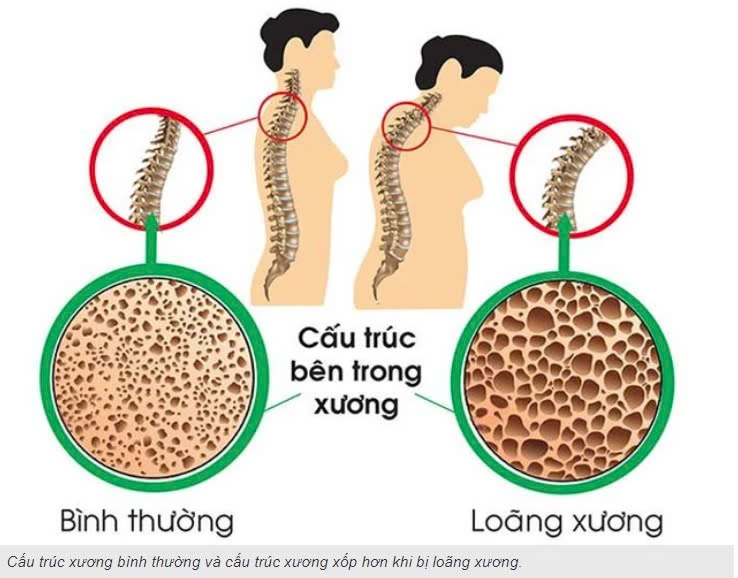 Phòng tránh loãng xương như thế nào?
