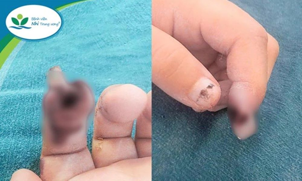 Bảo quản chi đúng cách