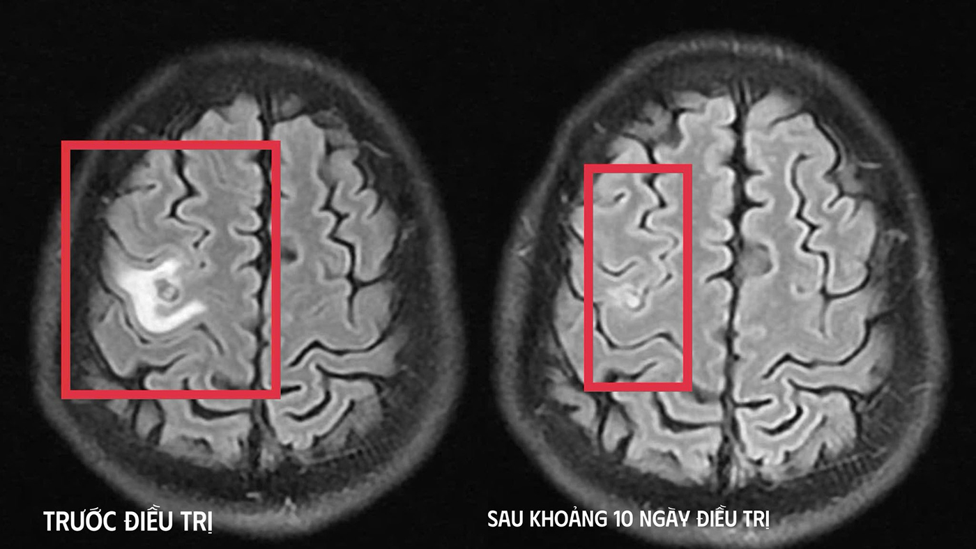 Điều trị thành công cho bệnh nhân bị tổn thương não do ký sinh trùng