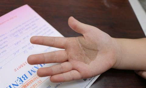 Bác sĩ của bạn: Thận trọng khi bị nhiễm nấm đen