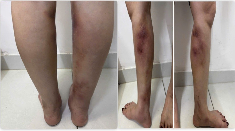 Cô gái gặp biến chứng nặng nề khi 