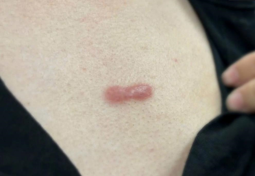 Không chủ quan với nốt mụn nhỏ      