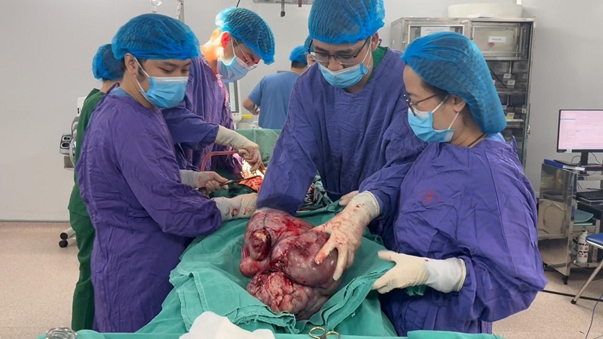Bệnh viện Ung Bướu H&agrave; Nội: Phẫu thuật khối u tử cung nặng gần 9kg