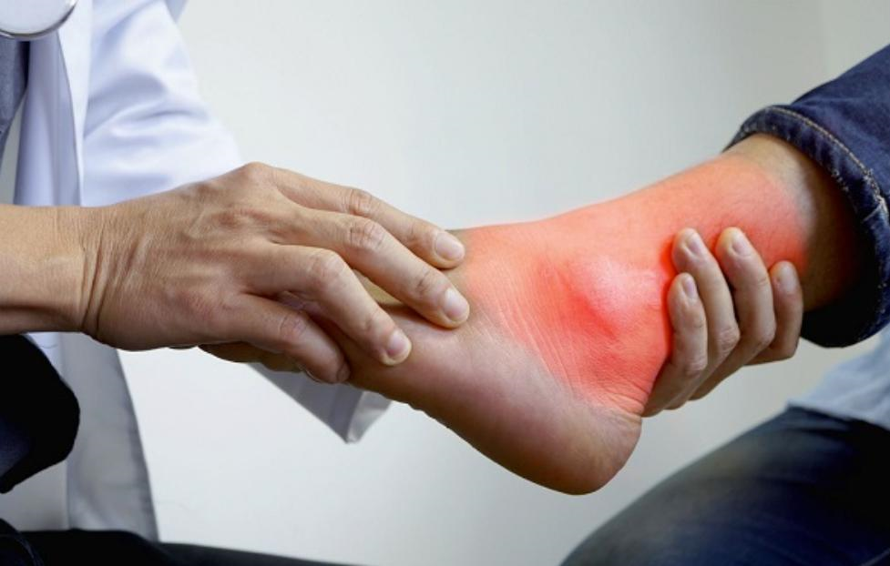 Nguy hiểm của biến chứng gout không điều trị