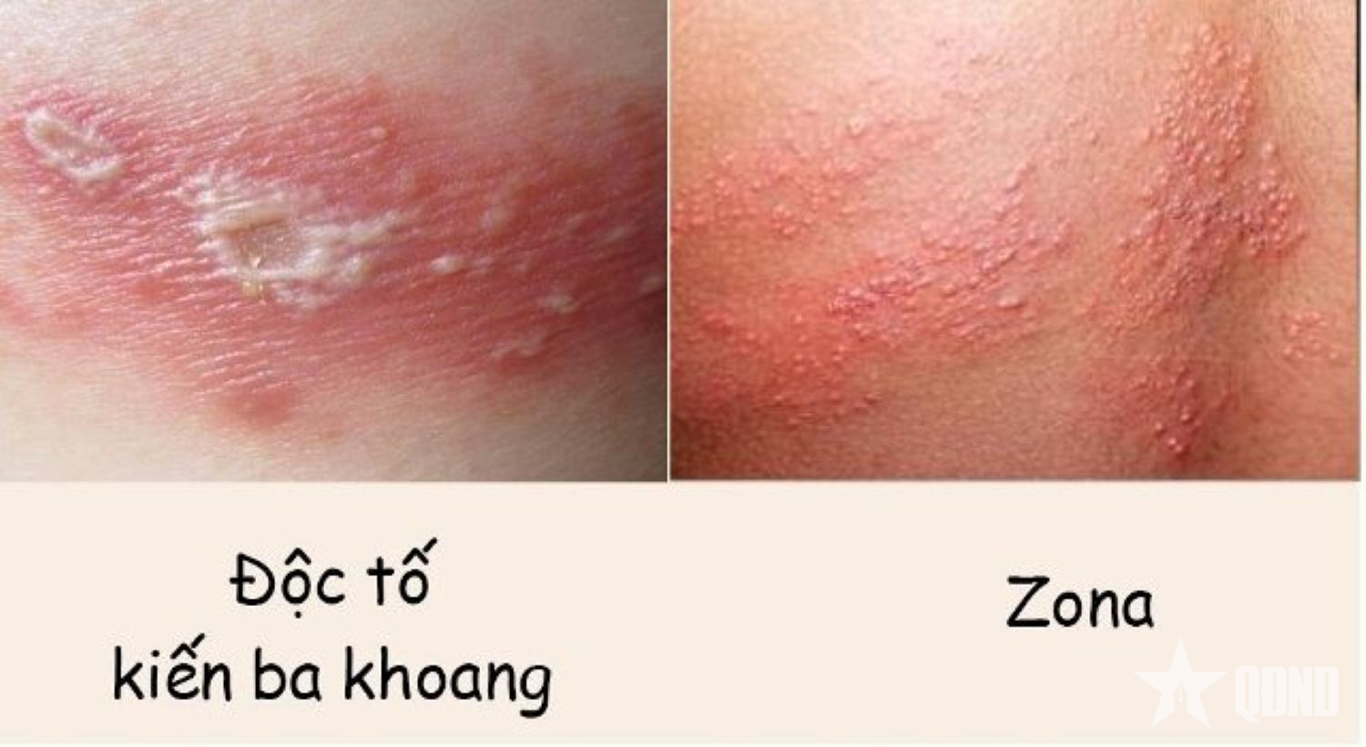 Phân biệt vết đốt của kiến ba khoang và zona thần kinh