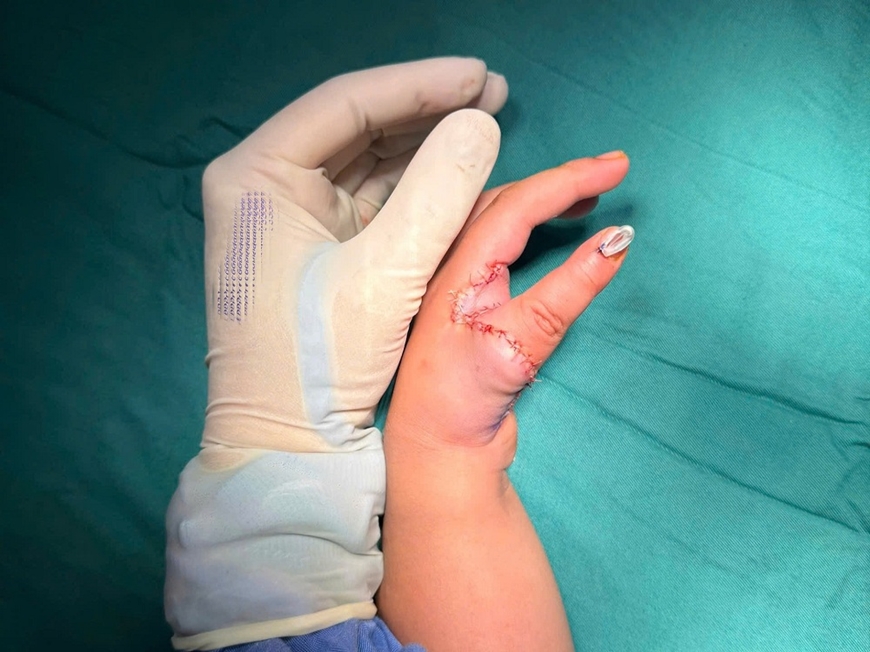 Bệnh viện Hữu nghị Việt Đức: Mở ra tương lai mới cho trẻ mắc dị tật thiểu sản ng&oacute;n c&aacute;i bẩm sinh