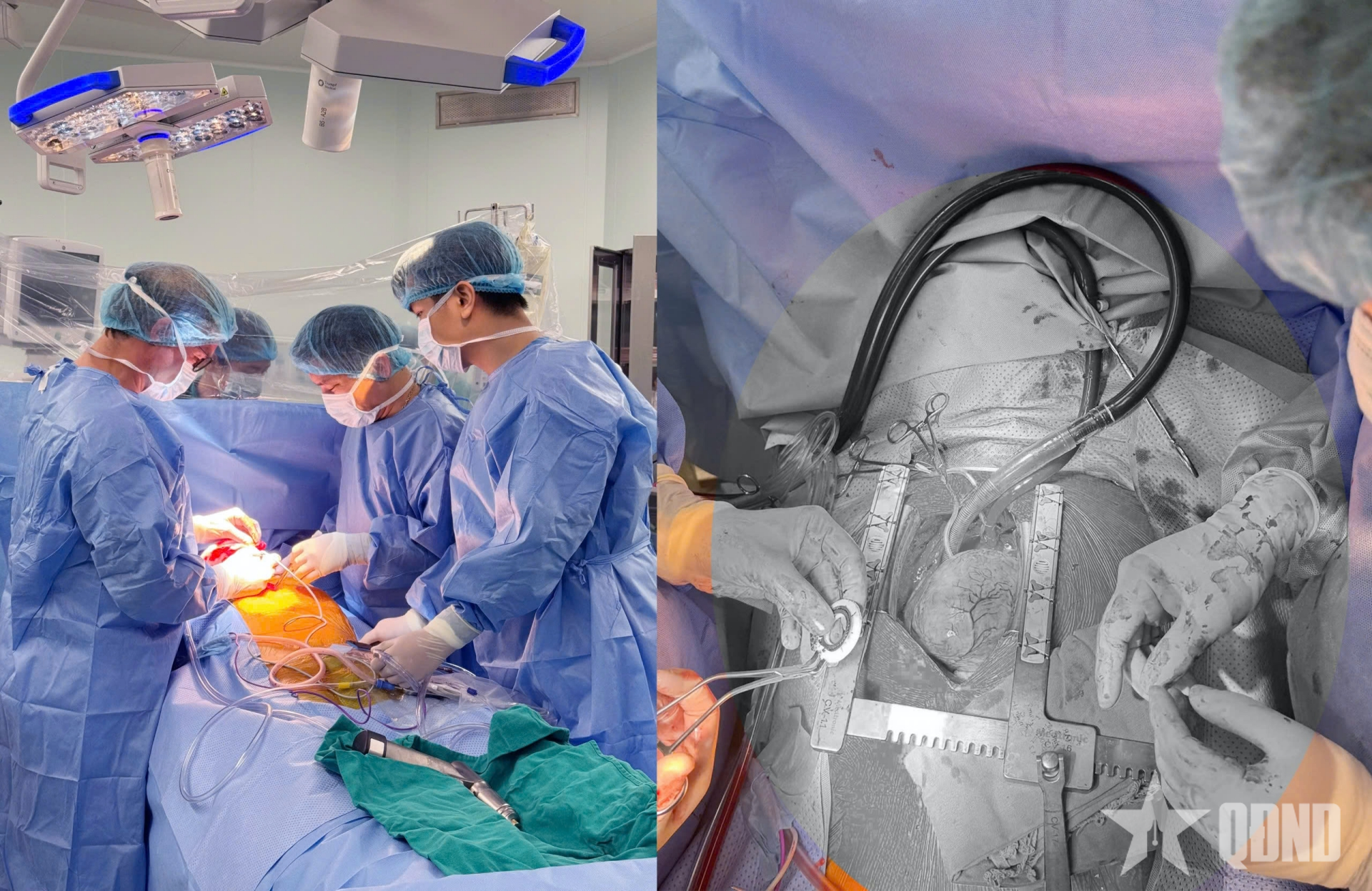 CorHeart 6-hy vọng mới cho bệnh nhân suy tim giai đoạn cuối