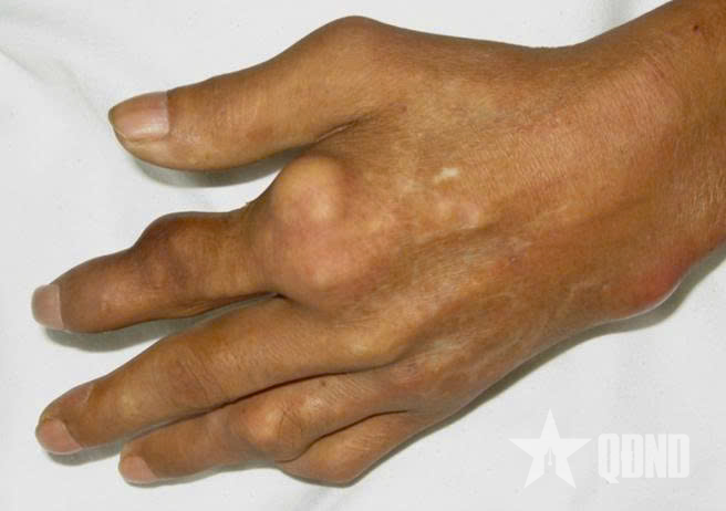 Gout mạn tính gây biến dạng khớp: Đừng để “viên sỏi” vô hình phá hủy vận động