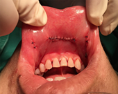 Phẫu thuật tuyến giáp qua đường tiền đình miệng